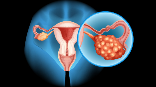 Imagem ilustrativa com um fundo preto em que se vê em primeiro plano a figura do aparelho reprodutivo feminino humano e, em destaque à direita, um tumor de ovário 